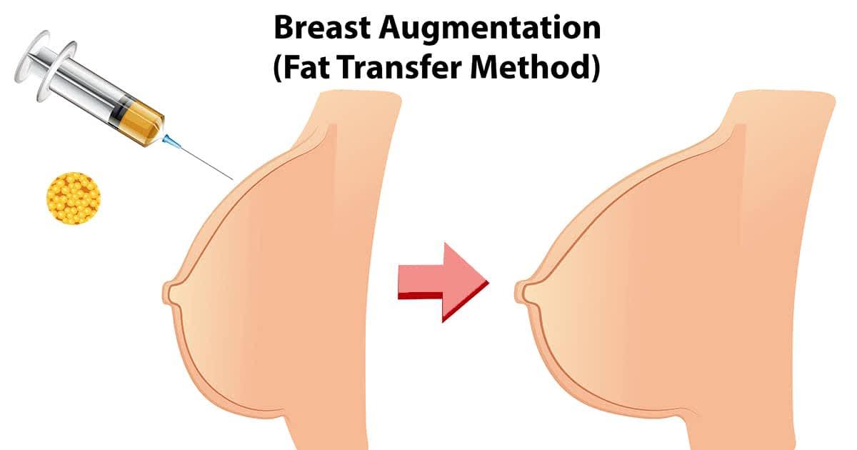 https://www.cheeseteeth.com/files/fat-injection-breast_241_1631422911.png